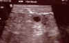 ultraschall_t21.jpg (46659 Byte)